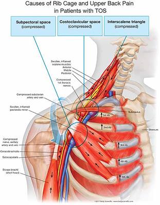 Diagnostic and Therapeutic Management of the Thoracic Outlet Syndrome. Review of the Literature and Report of an Italian Experience